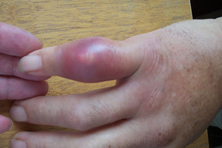 痛风初期手部红肿图