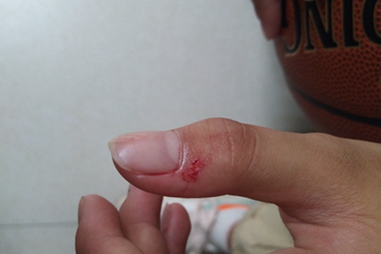 划伤手指症状图