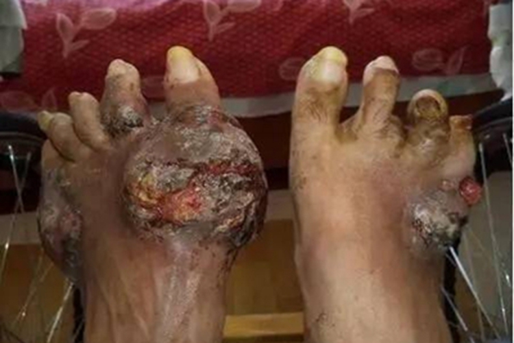 痛风晚期的症状图