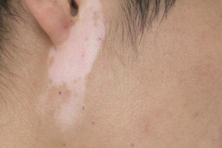 白癜风耳周白斑图 白癜风耳周白斑图