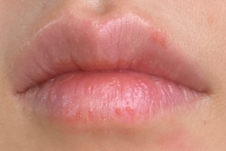 接触性唇炎嘴唇水疱症状图