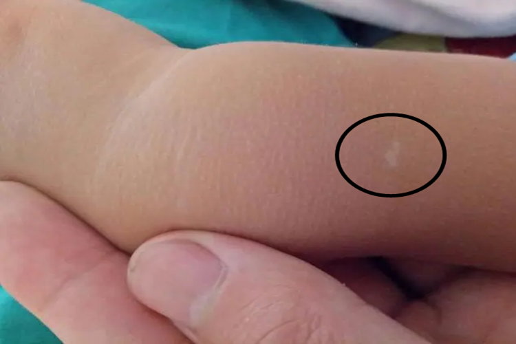 婴儿前臂白色胎记图 婴儿前臂白色胎记图