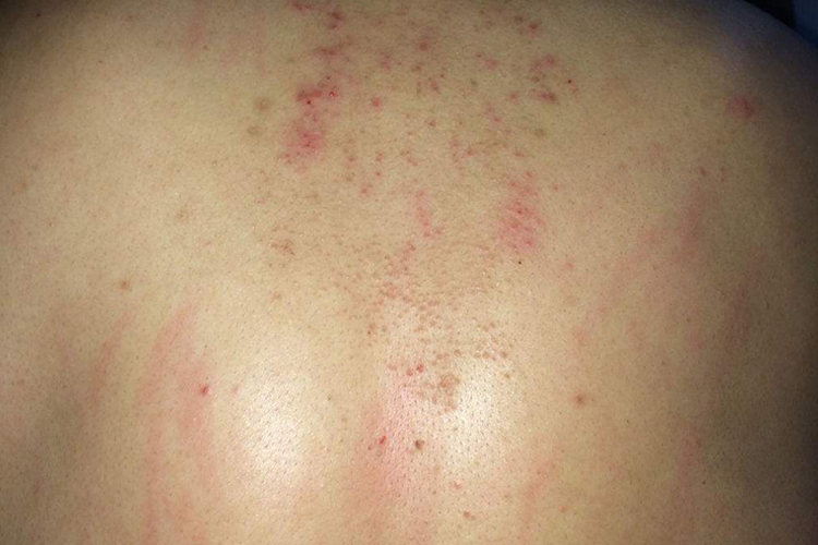 背部过敏性皮炎图