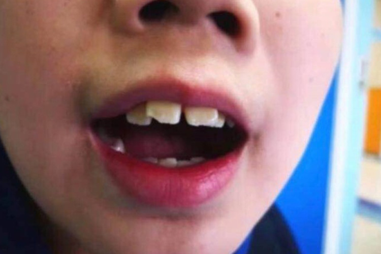 上切牙突出或咬合不良图