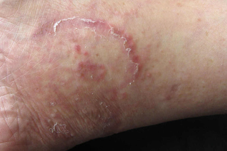 体癣初期环形红斑图