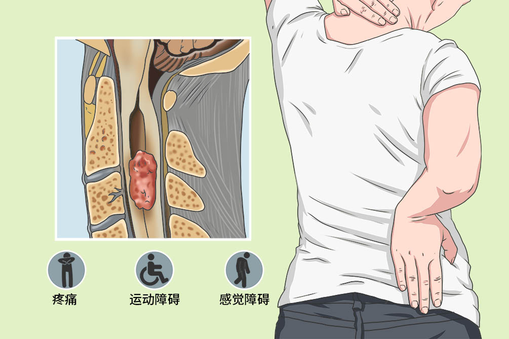 脊髓压迫症图