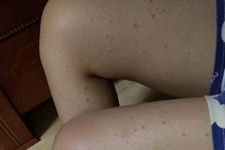 色素性紫癜性皮病大腿症状图