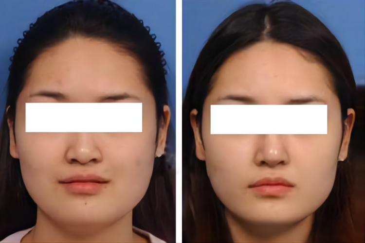 鼻翼外扩术前术后对比图 鼻翼外扩术前术后对比图