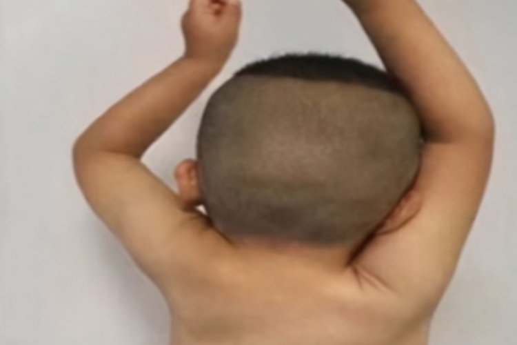 先天性高肩胛症肩部发育不良图