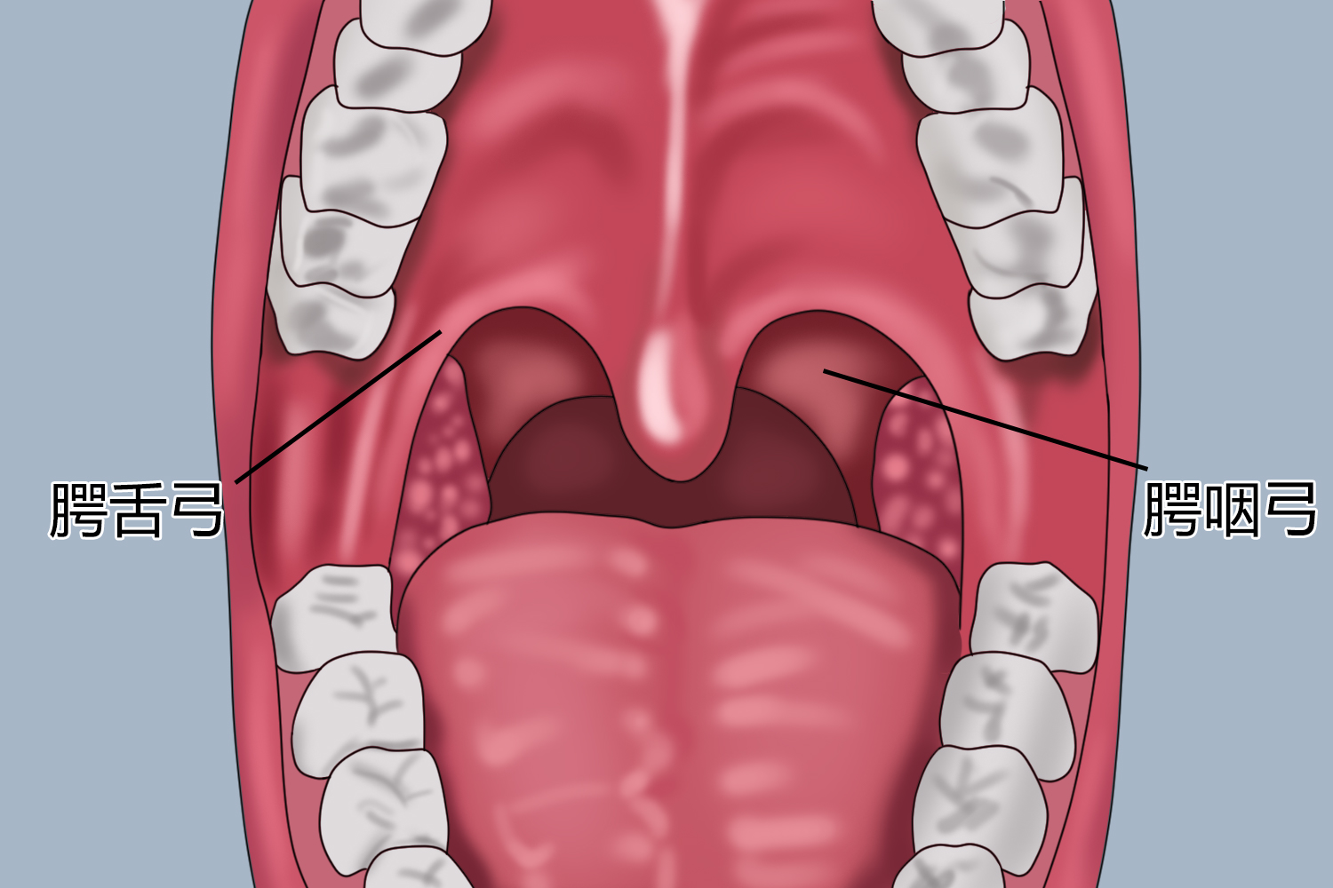 咽峡两侧腭舌弓及腭咽弓图