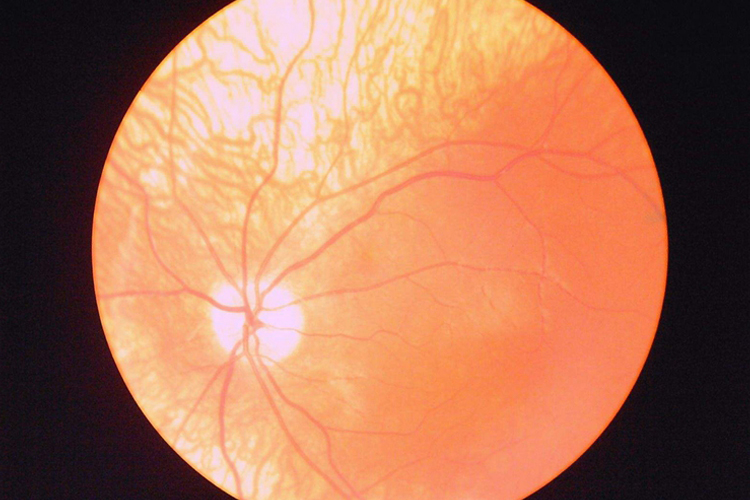 白化病人眼底图