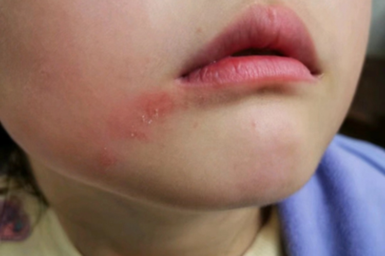 亚急性湿疹面部脱皮图