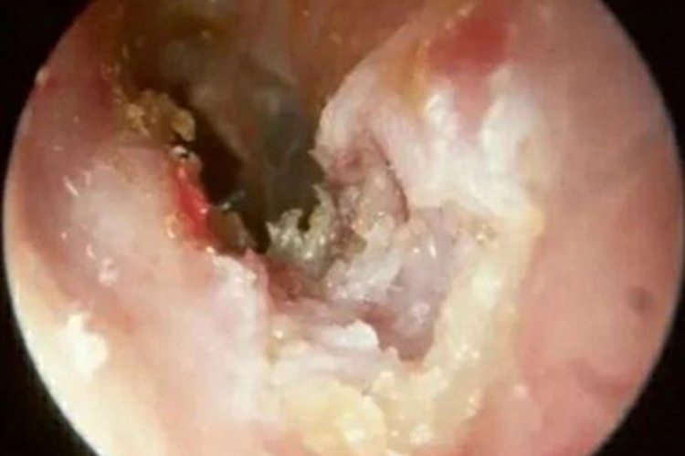 外耳道胆脂瘤化脓图