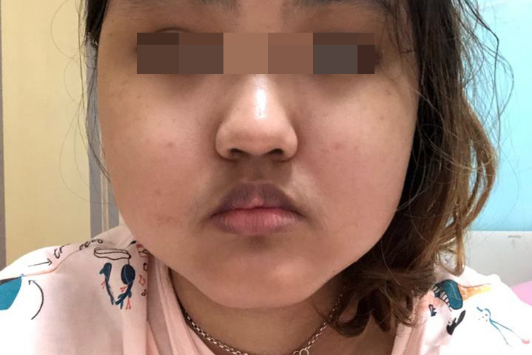 柯兴氏综合征满月脸图