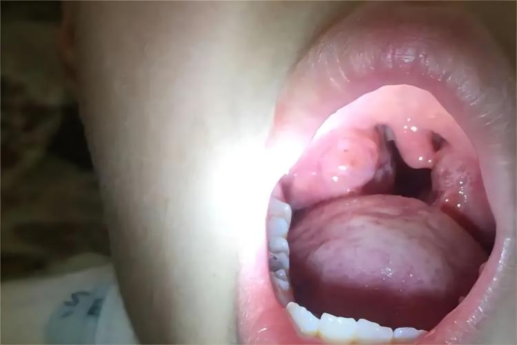 舌根淋巴组织增生症状图