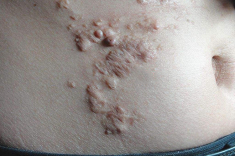 结缔组织痣腹部出现斑图 结缔组织痣腹部出现斑图
