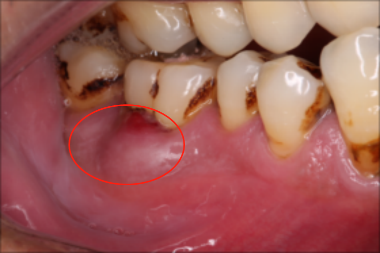牙周脓肿症状图