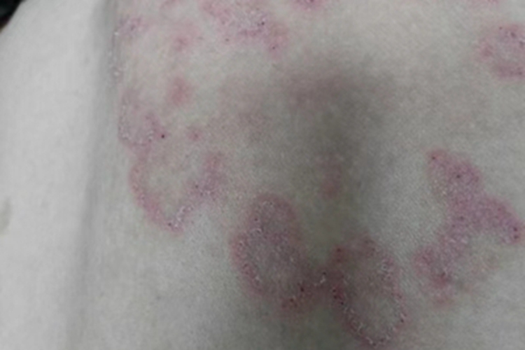 体癣背部一圈红色斑图