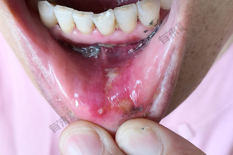 疱疹性龈口炎图