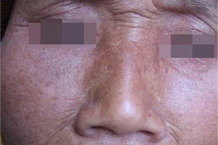 光老化面部长皱纹色斑图