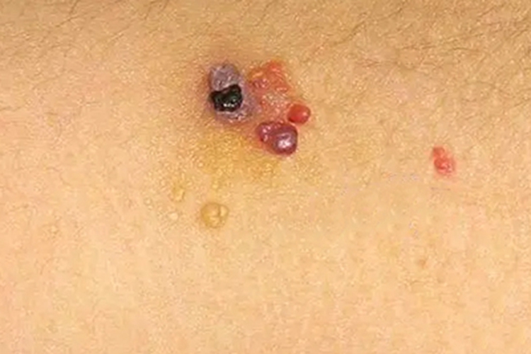局限性血管角皮瘤图