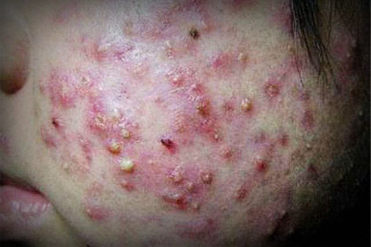 肺热型痘痘图 肺热型痘痘图