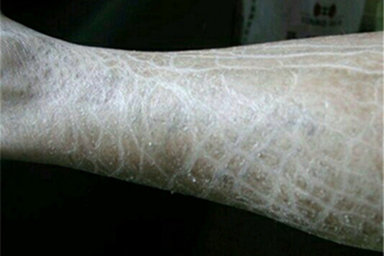 获得性鱼鳞病小腿脱屑图 获得性鱼鳞病小腿脱屑图