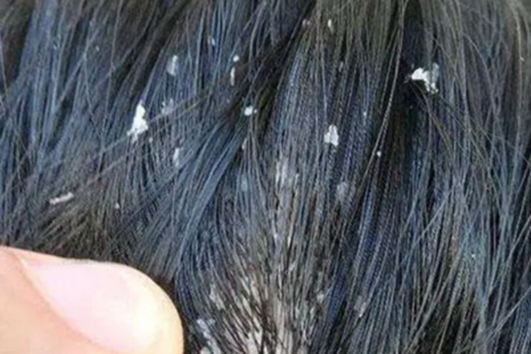 头部单纯糠疹头皮脱屑图