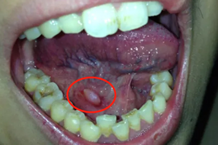 右侧舌下腺囊肿图 右侧舌下腺囊肿图