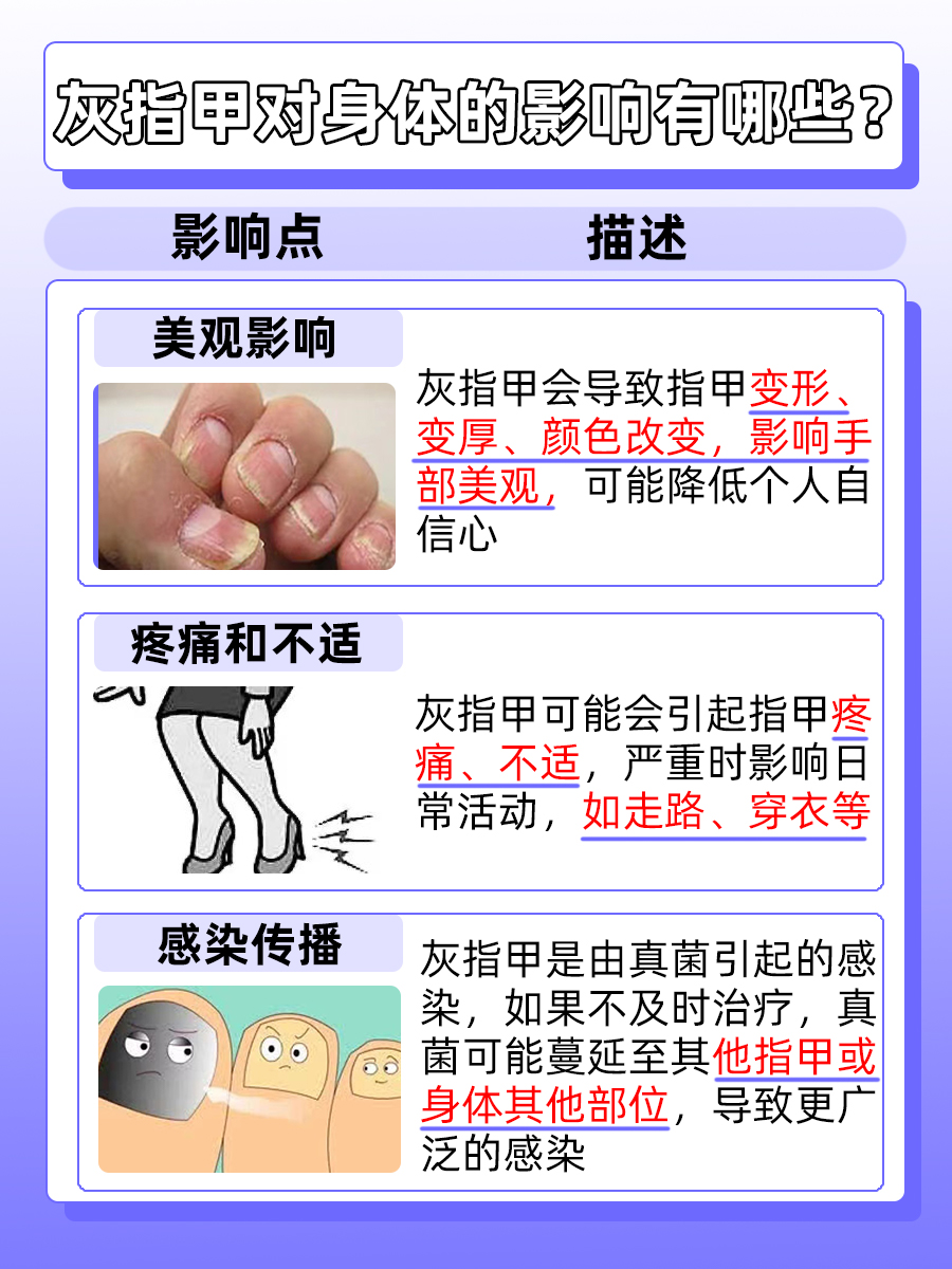 伊曲康唑：正确使用助力灰指甲治疗