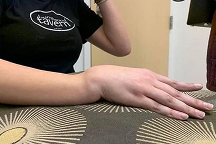 手腕桡骨远端骨折图