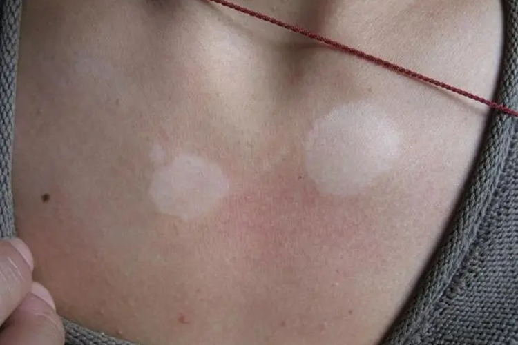 花斑癣胸口长斑图 花斑癣胸口长斑图