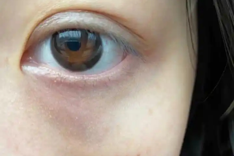 血管性黑眼圈图