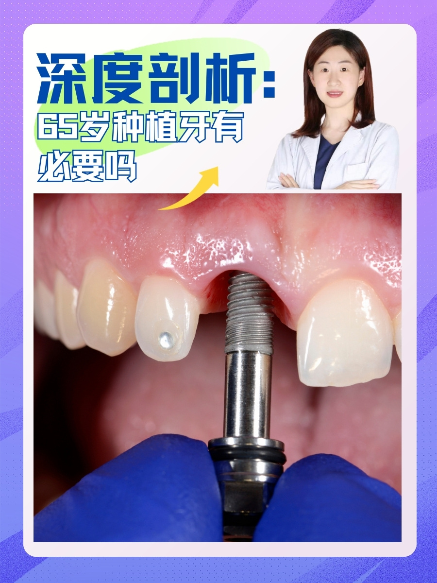 深度剖析：65岁种植牙有必要吗