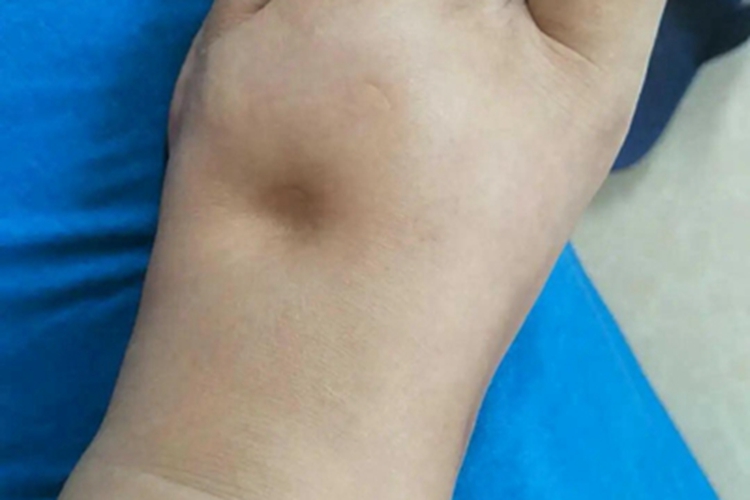 蛋白质营养不良脚浮肿图