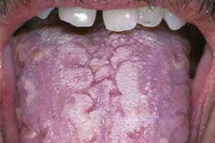 口腔白斑病舌头白斑突起图 口腔白斑病舌头白斑突起图