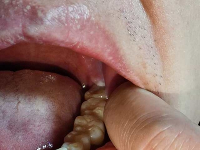 智齿冠周炎智齿牙龈出现溃疡图