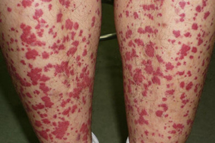 冷球蛋白血症小腿紫斑图