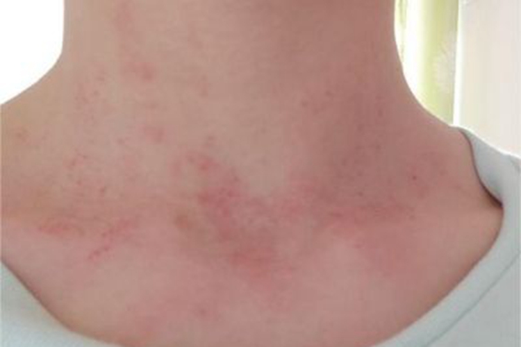 湿疹型多形性日光疹前颈红点图