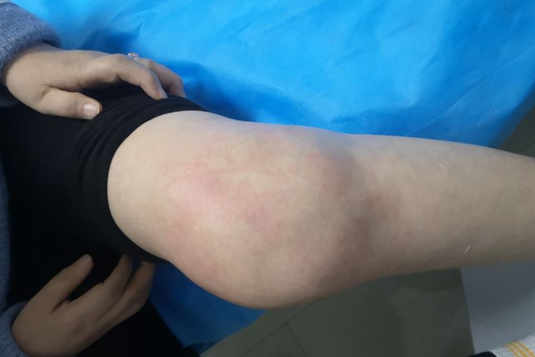 风湿性关节炎膝关节肿痛图 风湿性关节炎膝关节肿痛图