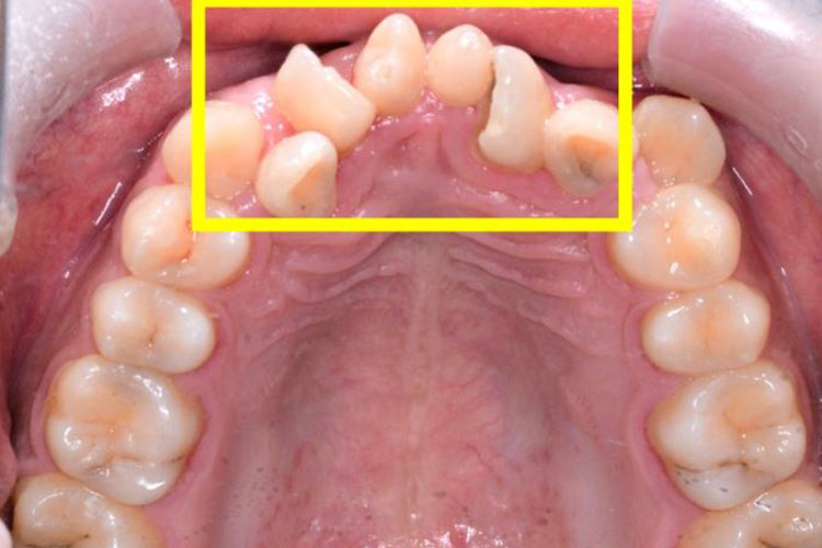 多生牙一颗门牙竖着长图 多生牙一颗门牙竖着长图