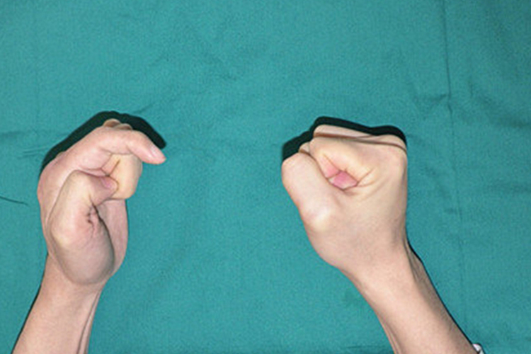 手指肌腱粘连图