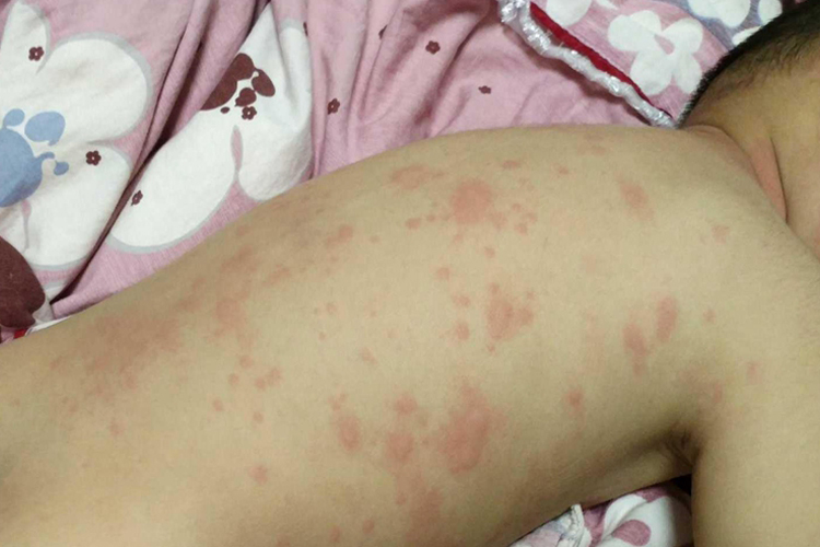 宝宝牛肉过敏皮疹图