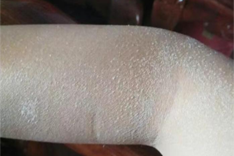 维生素A缺乏症胳膊皮肤粗糙图