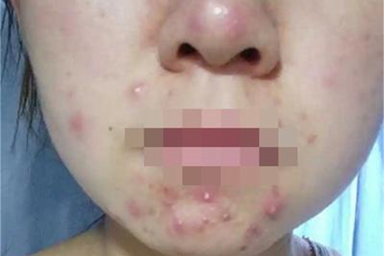 化妆品性痤疮口周症状图