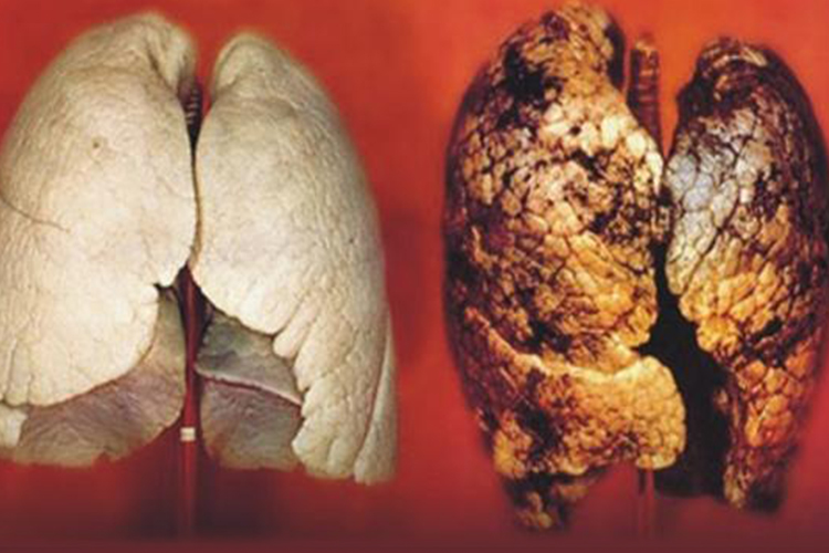 正常人和吸烟人的肺对比图