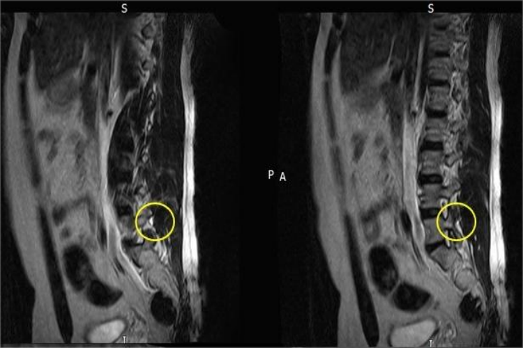 腰椎小关节紊乱关节内积液图