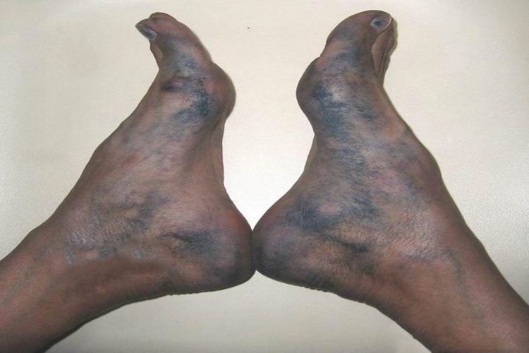 身体出现蓝色汗液图