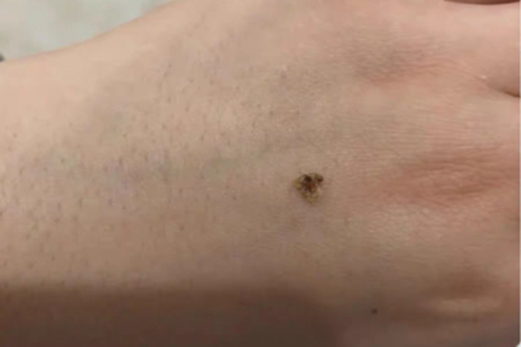 复合痣手背症状图