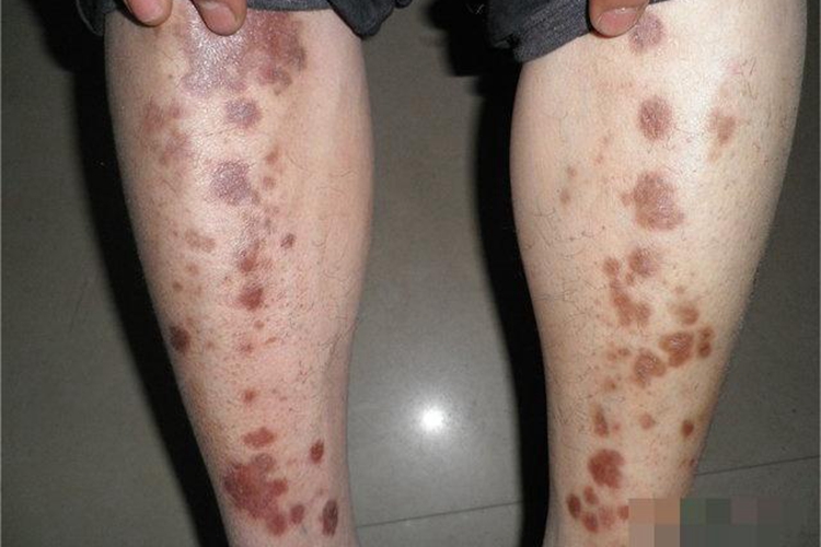 持久性隆起性红斑腿丘疹图